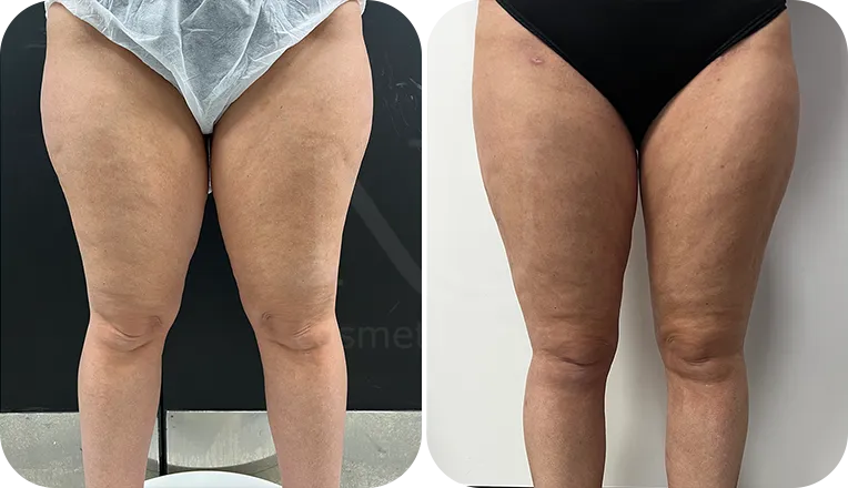 Thigh Lift London, Thigh Reduction Surgery UK