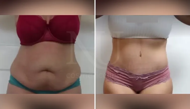 tummy tuck patient before and after result-1