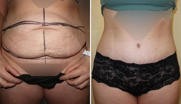 tummy tuck patient before and after result-2