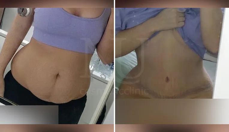 tummy tuck patient before and after result