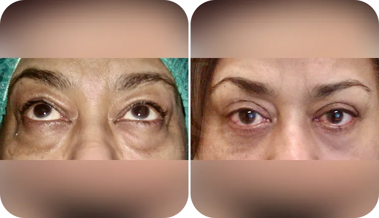 under eye blepharoplasty patient before and after result-1