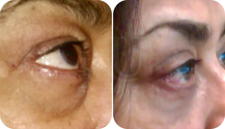 under eye blepharoplasty patient before and after result-2