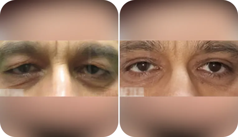 under eye blepharoplasty patient before and after result
