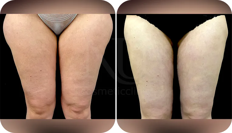 vaser lipo legs patient before and after result-1