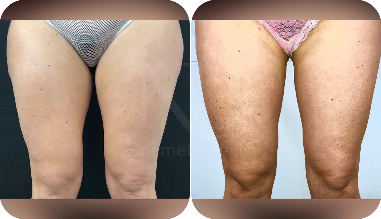 vaser lipo legs patient before and after result-2