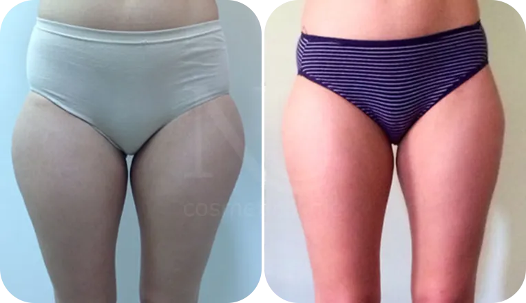 vaser lipo legs patient before and after result-3