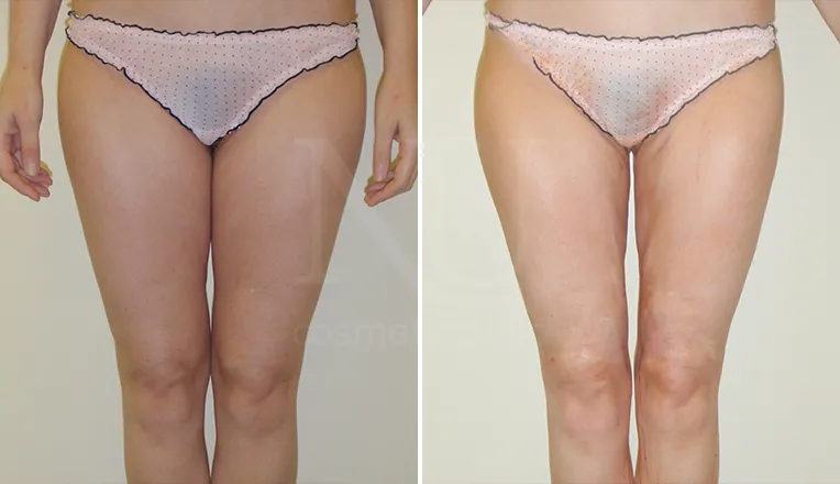 vaser lipo legs patient before and after result