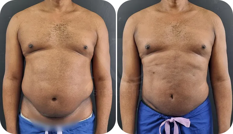 Vaser Liposuction for Lipedema Treatment - Welfare Abroad