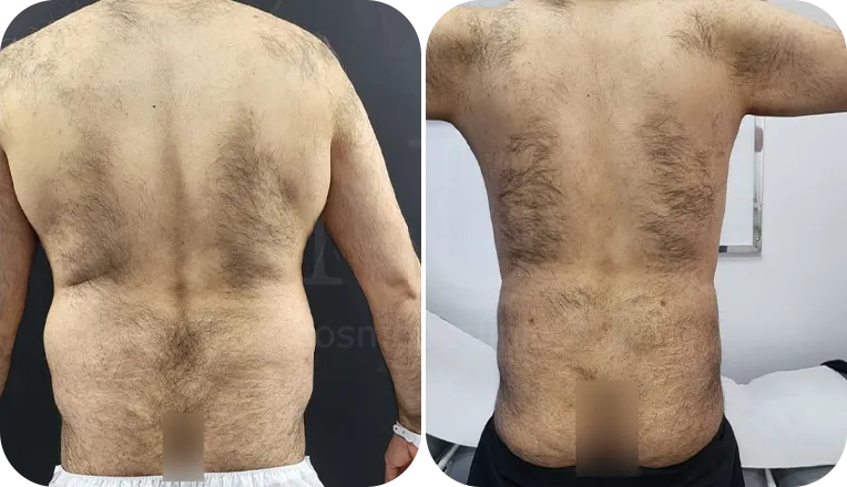 vaser lipo male before and after result-2