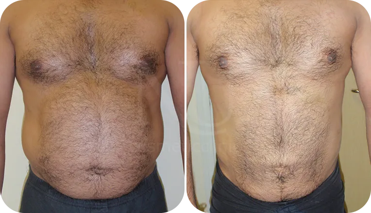 vaser lipo male before and after result-3