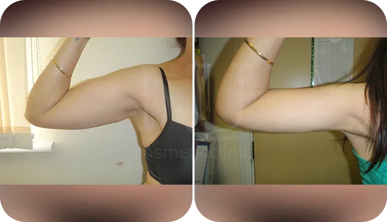 vaser lipo on arms before and after result patient-1-v1