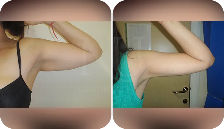 vaser lipo on arms before and after result patient-1-v2