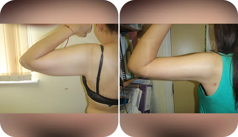 vaser lipo on arms before and after result patient-1-v3
