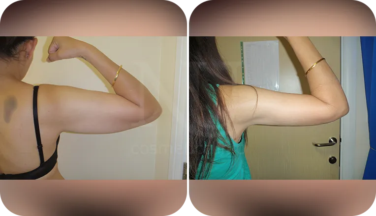 vaser lipo on arms before and after result patient-1-v4