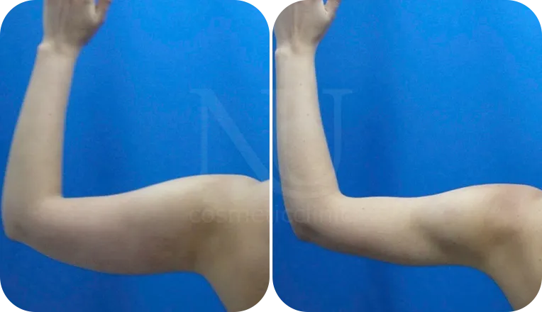 vaser liposuction arms before and after result patient-1-v1