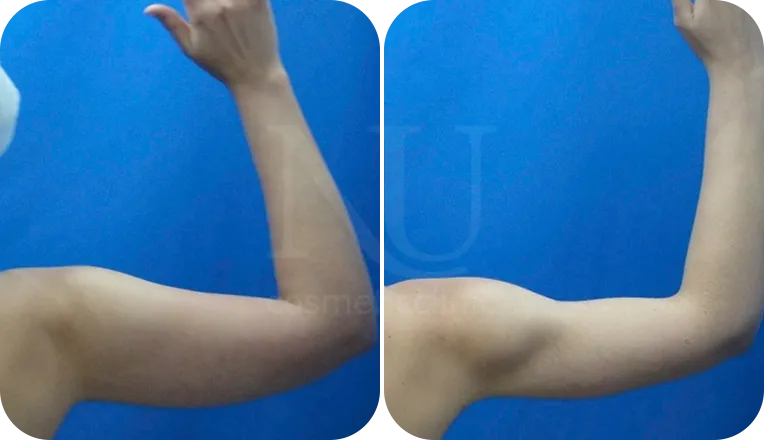 vaser liposuction arms before and after result patient-1-v2