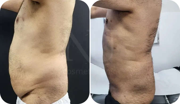 vaser liposuction male before and after result-1