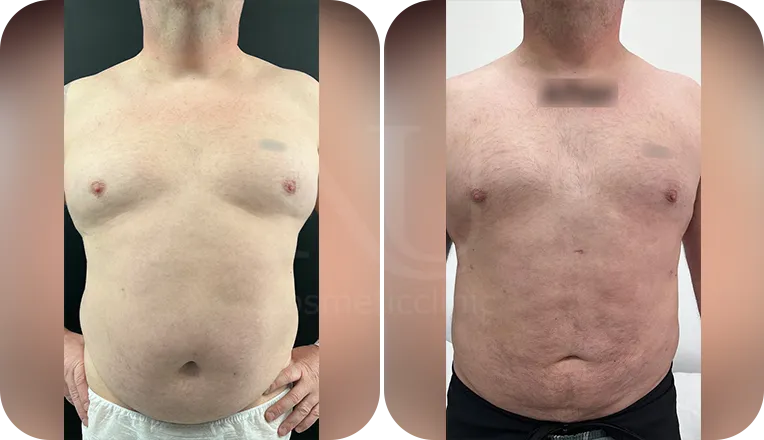 vaser liposuction male before and after result-3