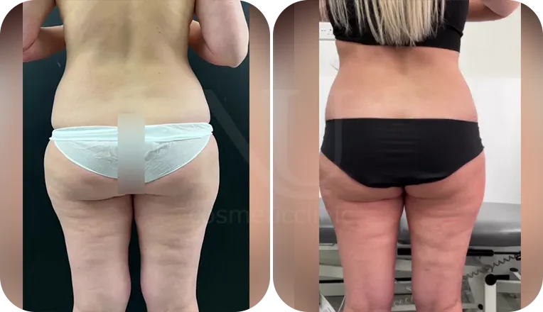 back liposuction patient before and after result-1