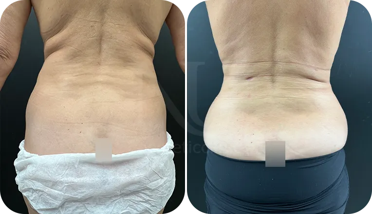 back liposuction patient before and after result