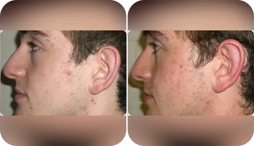 ear correction before and after result-1