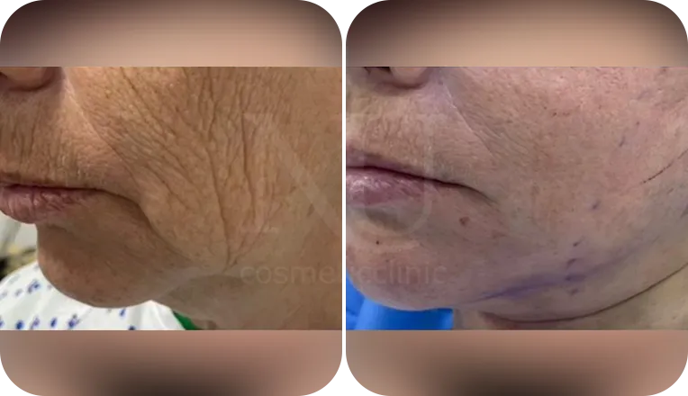facelift patient before and after result-1
