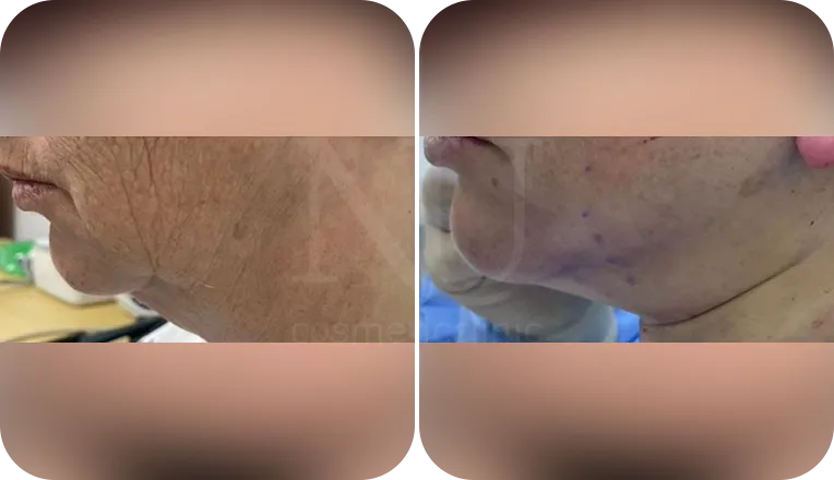 facelift patient before and after result-3