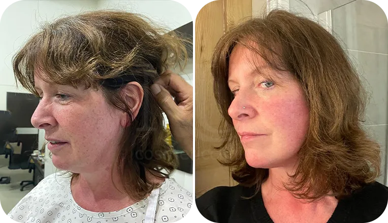 facelift patient before and after result-4