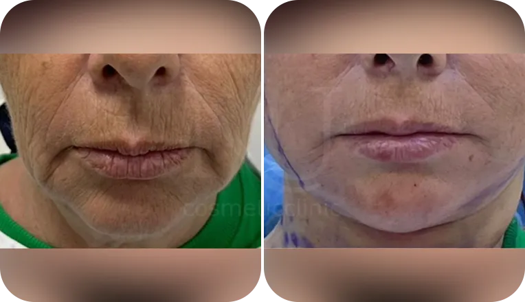facelift patient before and after result