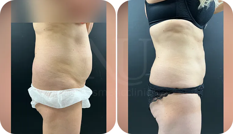 liposuction patient before and after result-1