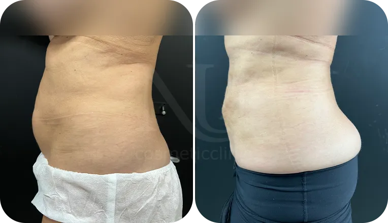 liposuction patient before and after result-2