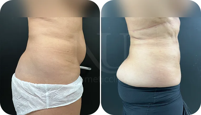 liposuction patient before and after result-3