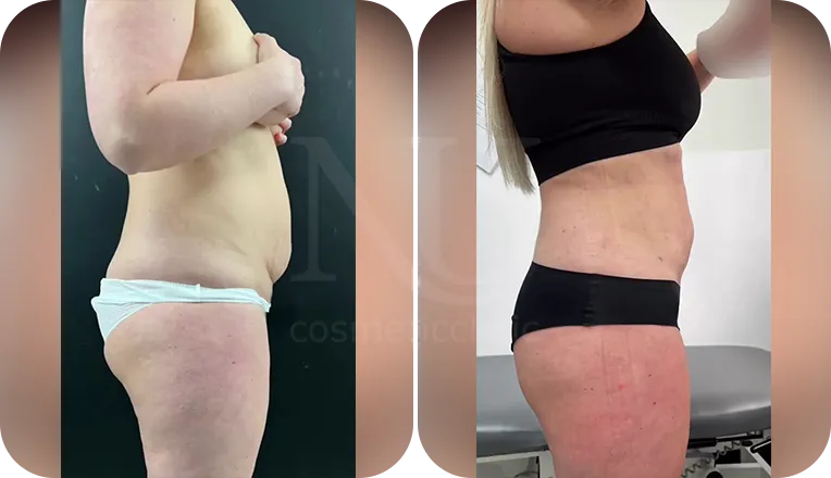 liposuction patient before and after result-4