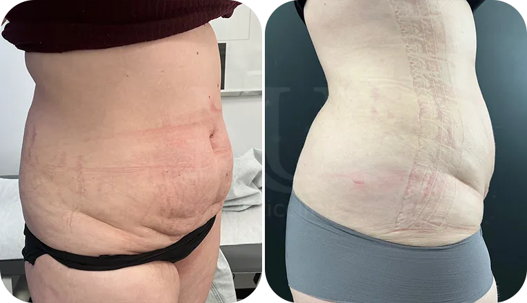liposuction patient before and after result-7
