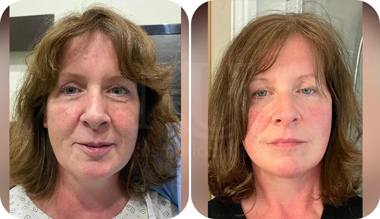 lower facelift patient before and after result