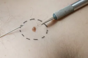 FAQs Mole Removal