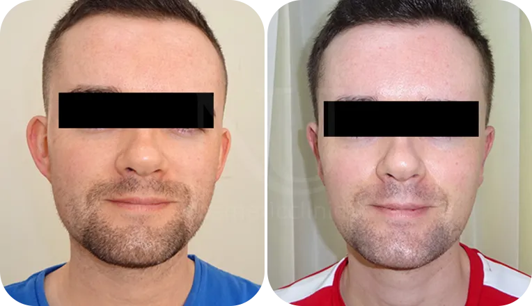 otoplasty patient before and after result-3