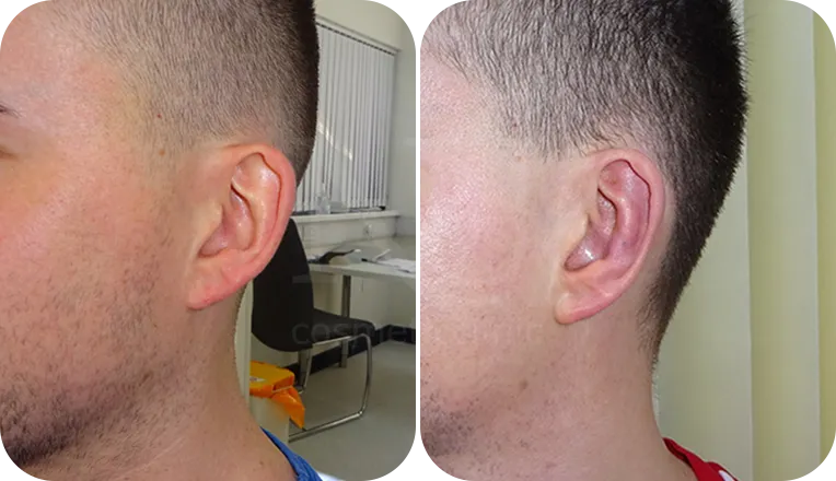 otoplasty patient before and after result