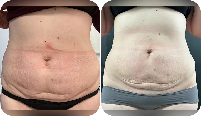 stomach lipo patient before and after result