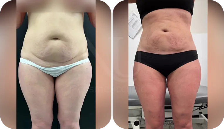 stomach liposuction patient before and after result-1