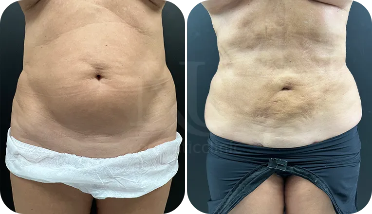 stomach liposuction patient before and after result