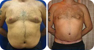 tummy tuck male patient before and after result